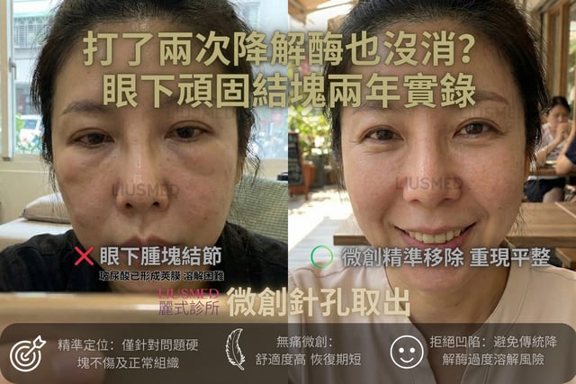 眼下那顆「凸凸」的東西,跟了我三年...