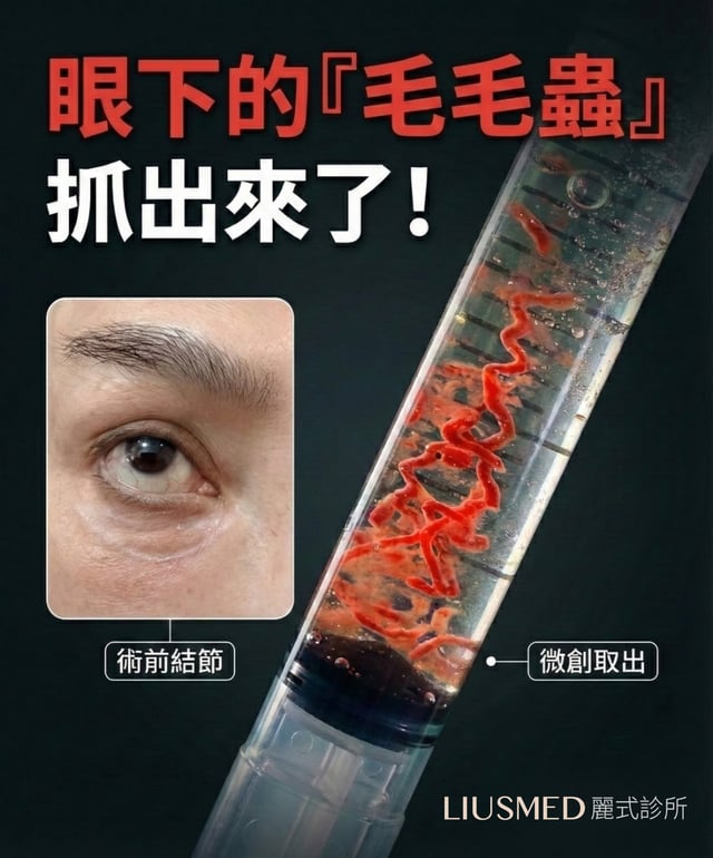 眼下伊蓮絲結節,趕在過年前請出來