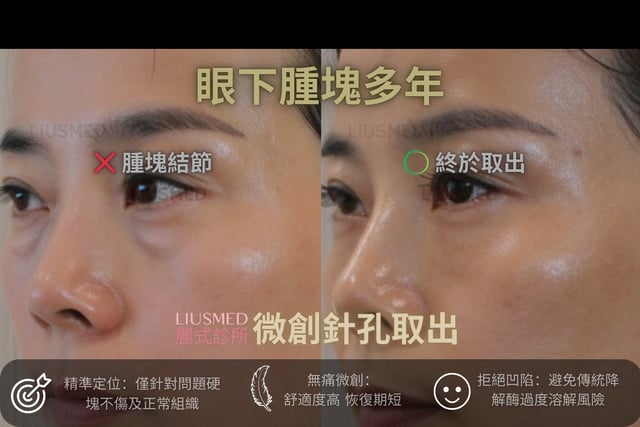 伊蓮絲蘋果肌「饅化」,笑起來像麵包超人