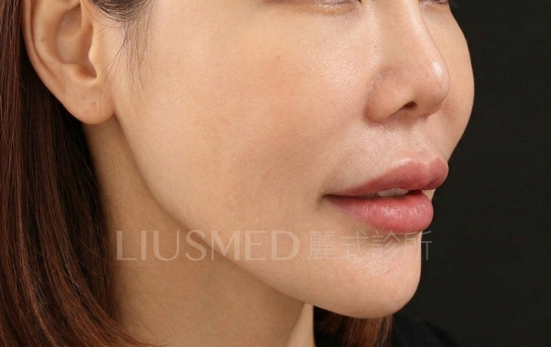 法令紋及上唇突出肥厚